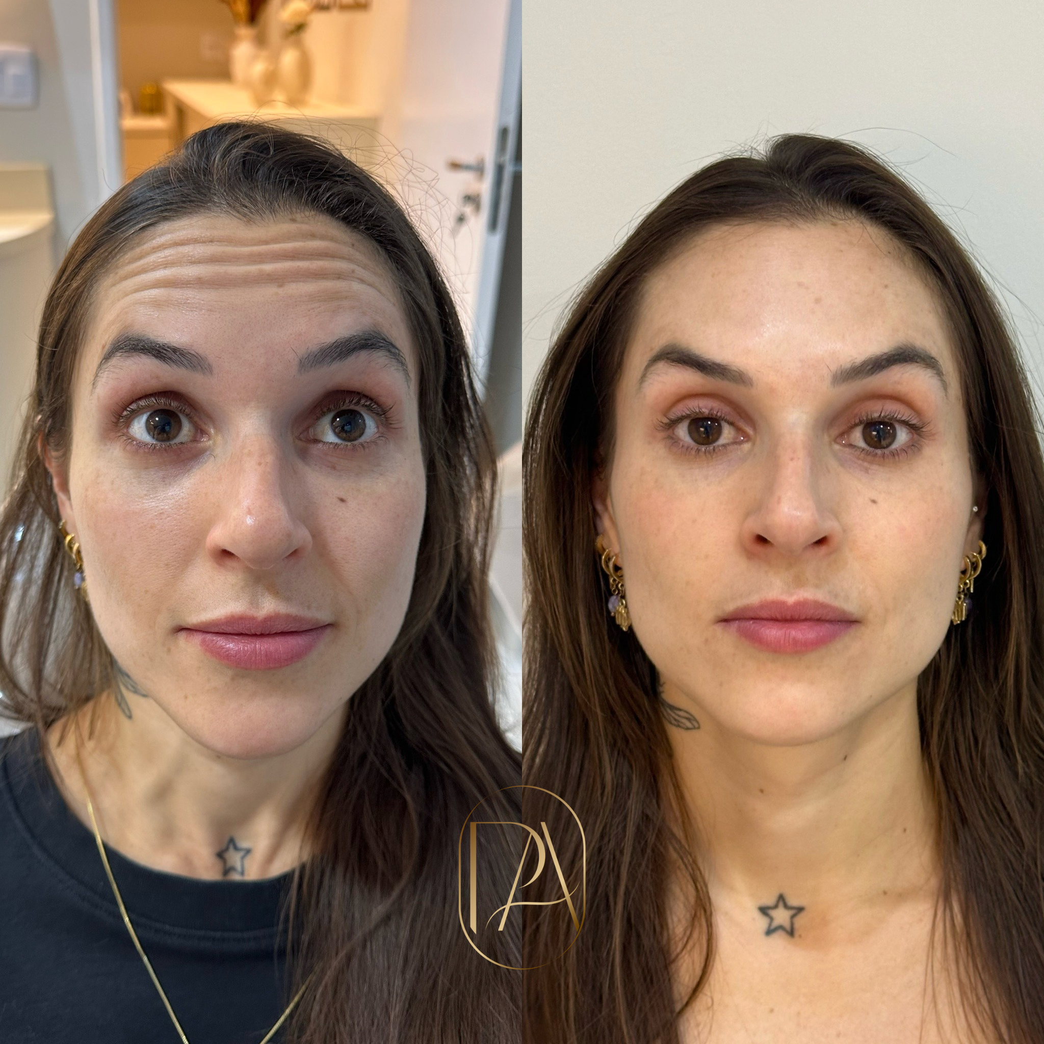 Antes e depois — botox na testa