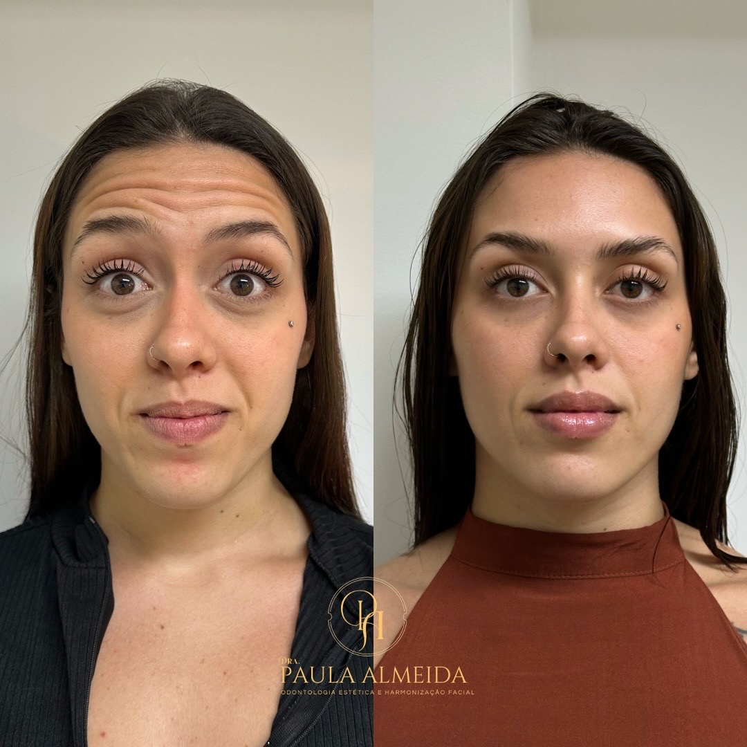 Antes e depois do tratamento de botox — testa lisa, expressao preservada