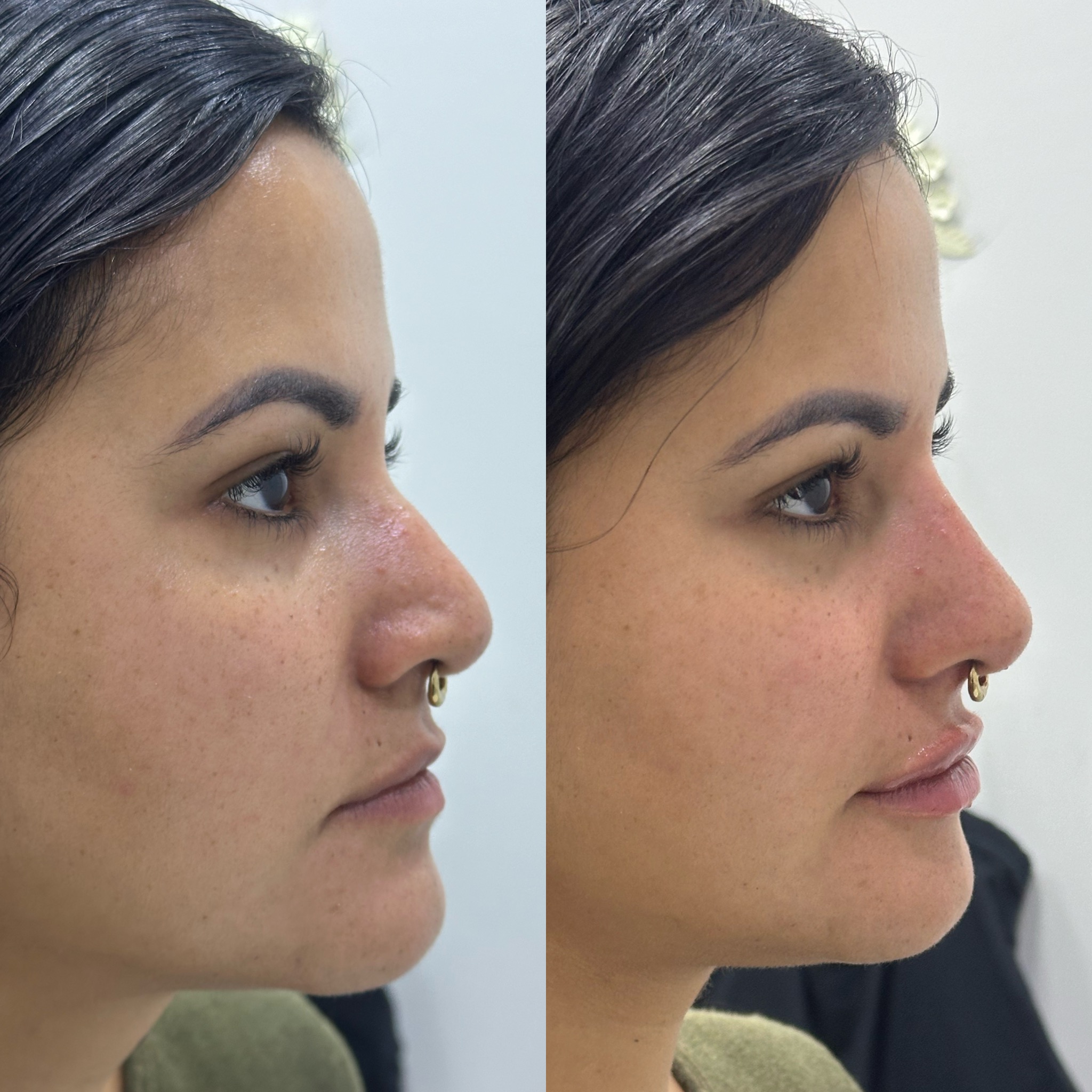 Antes e depois — harmonização do nariz