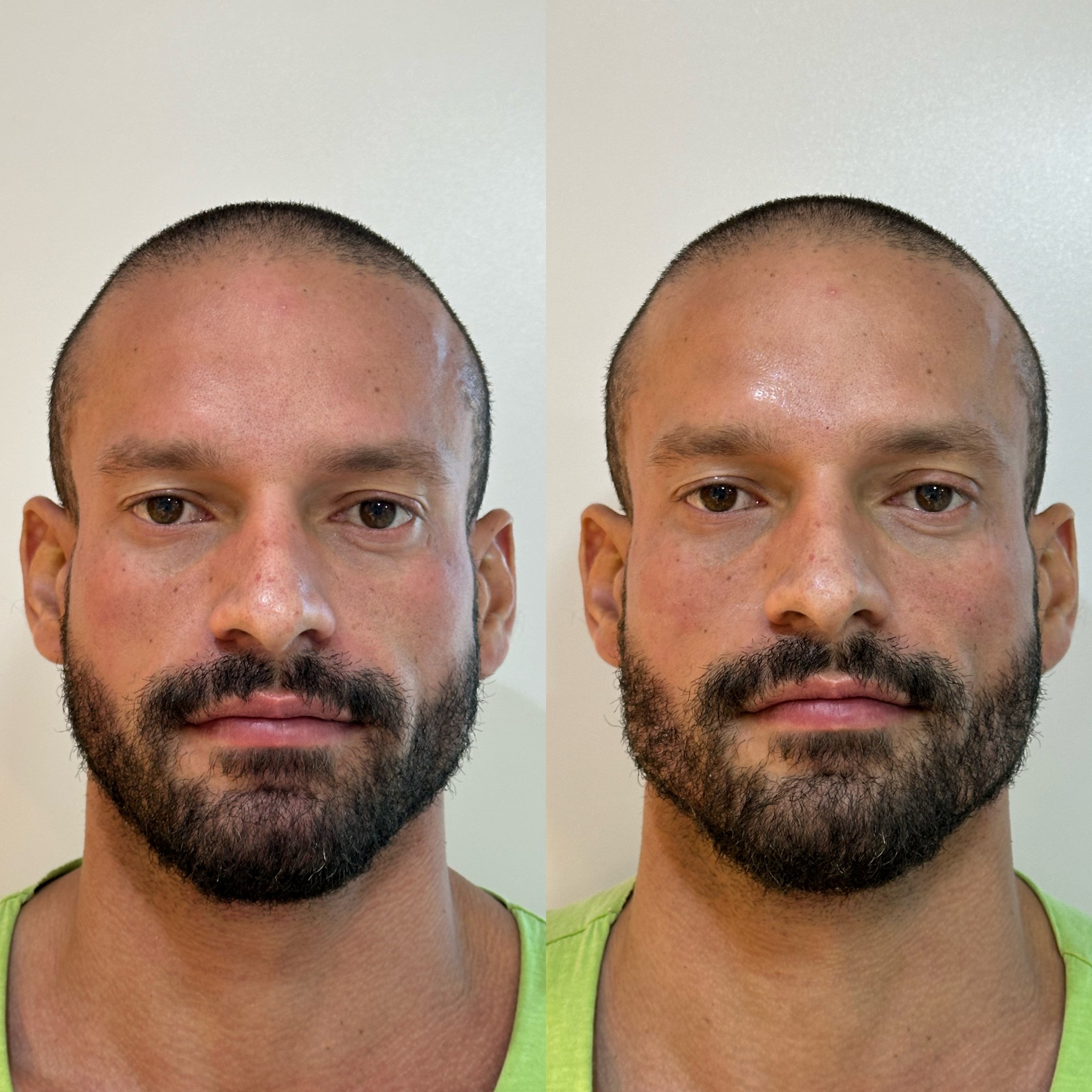 Antes e depois — harmonização facial masculina