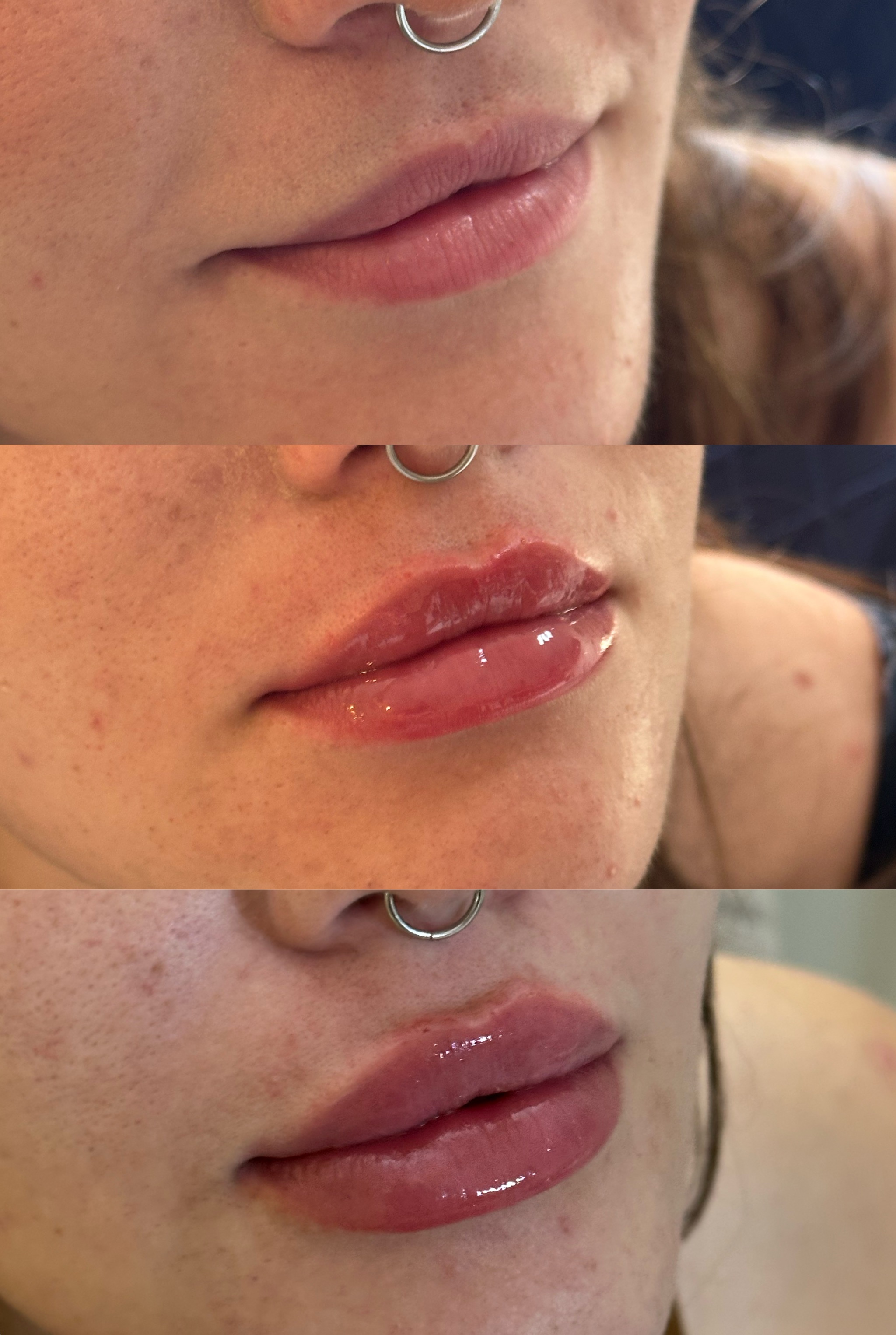 Evolução do preenchimento labial — antes, 1ml e 2ml